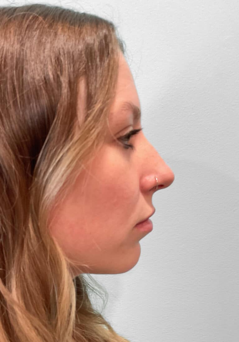 Before Image: Juvéderm Ultra – Heather - front