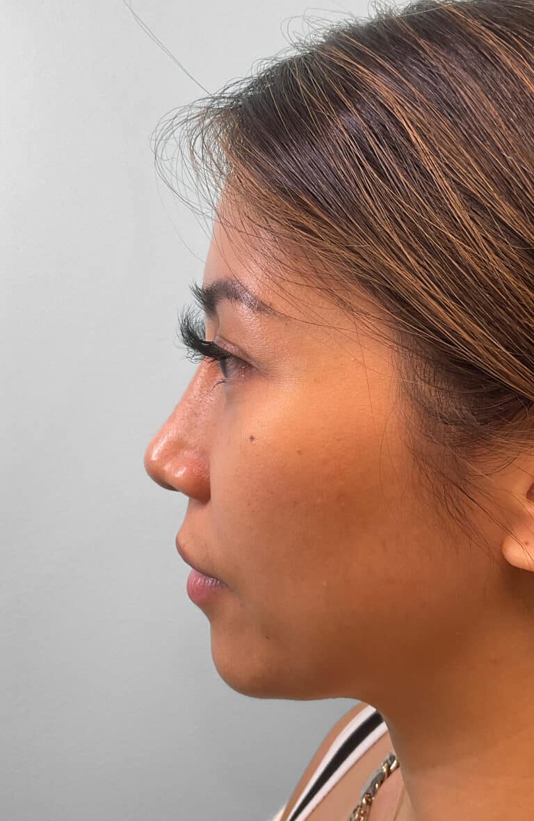 Before Image: Juvéderm Volbella & Botox – Heather - left-side