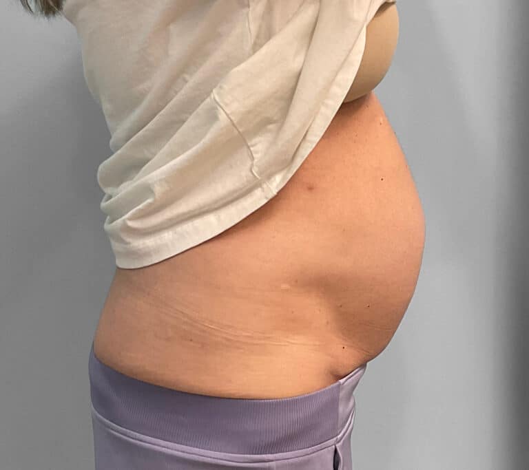 Before Image: Emsculpt Neo- Jessica - right-side