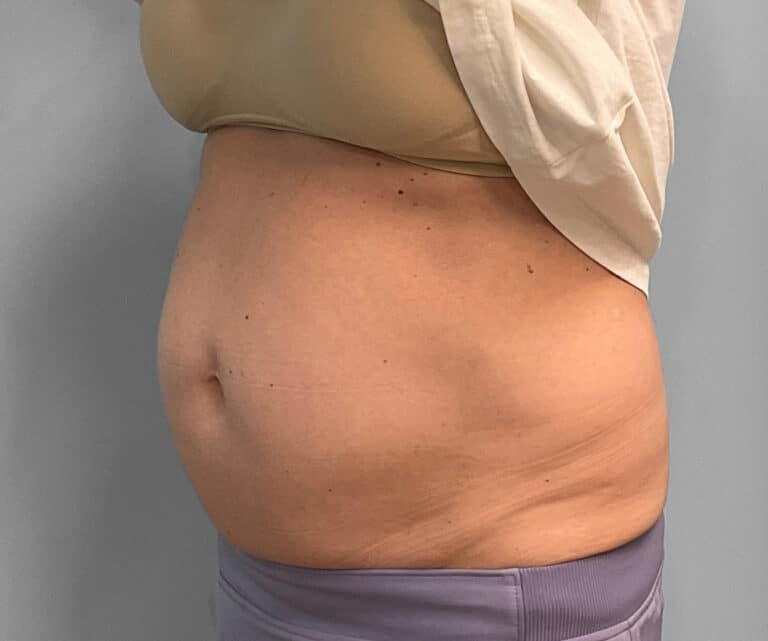 Before Image: Emsculpt Neo- Jessica - left-front-oblique