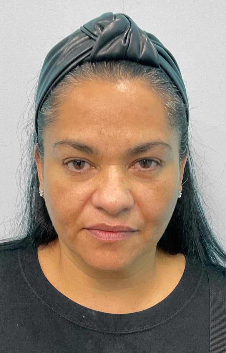 After Image: Botox & Juvéderm- Joy - front