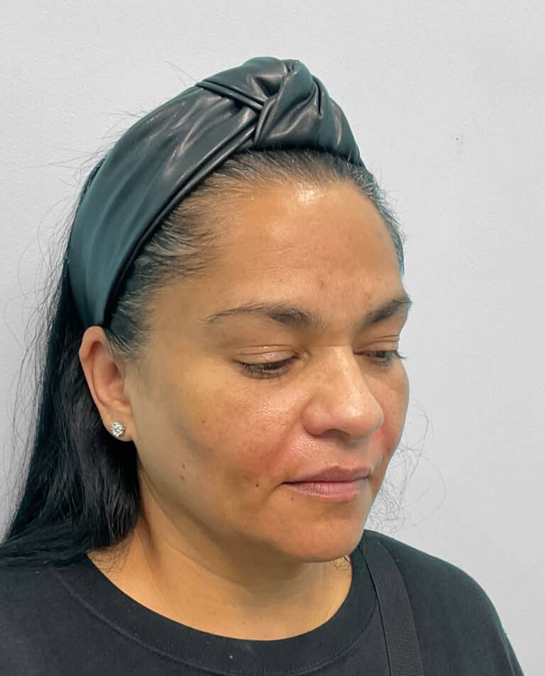 After Image: Botox & Juvéderm- Joy - right-front-oblique