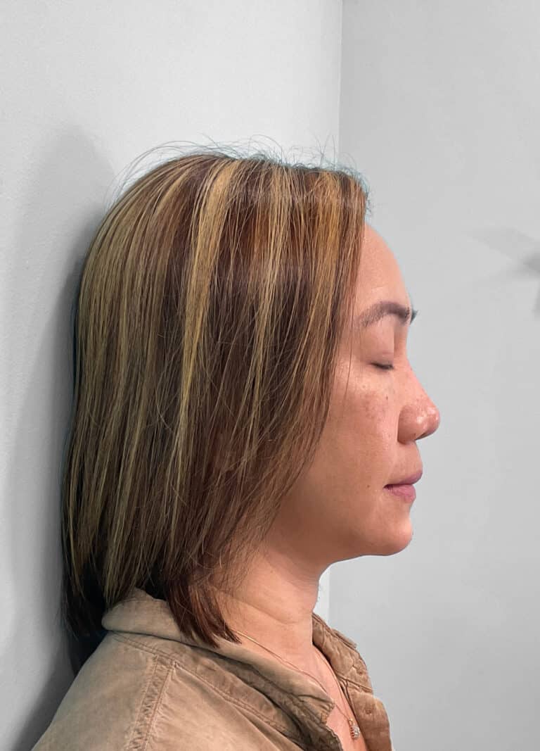 After Image: Juvéderm Voluma- Joy - right-side