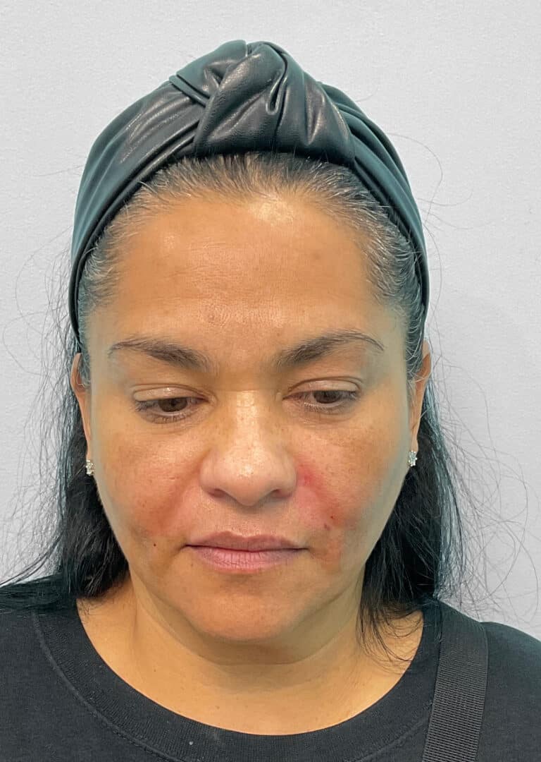 After Image: Botox & Juvéderm- Joy - front