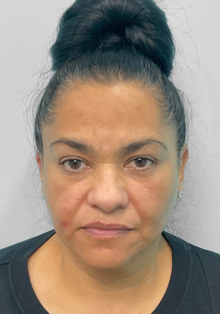 Before Image: Botox & Juvéderm- Joy - front