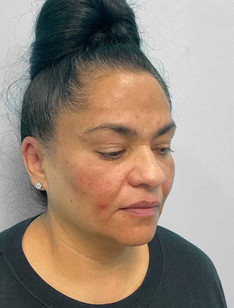 Before Image: Botox & Juvéderm- Joy - right-front-oblique