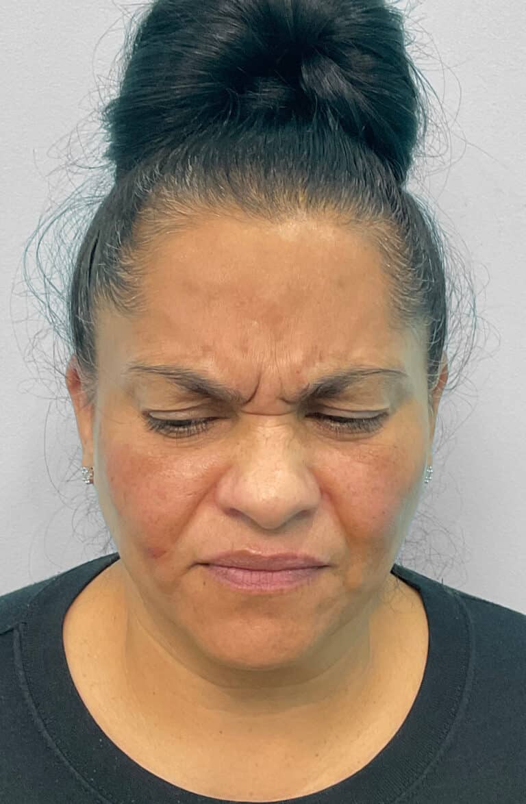 Before Image: Botox & Juvéderm- Joy - front