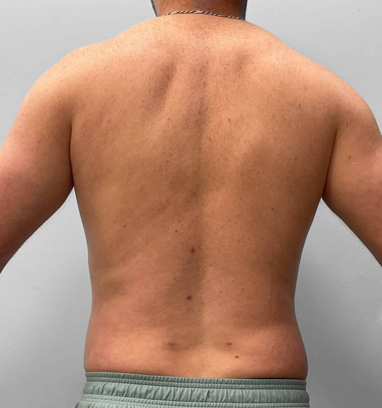After Image: Liposuction – Dr. Tucker -