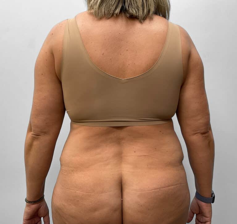 After Image: Abdominoplasty & Liposuction – Dr. Tucker - back