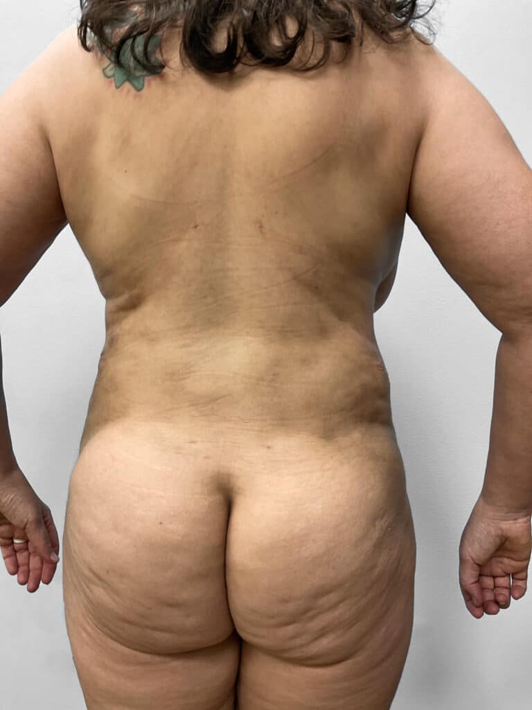 After Image: Tummy Tuck, Lipo, & BBL – Dr. Tucker - back