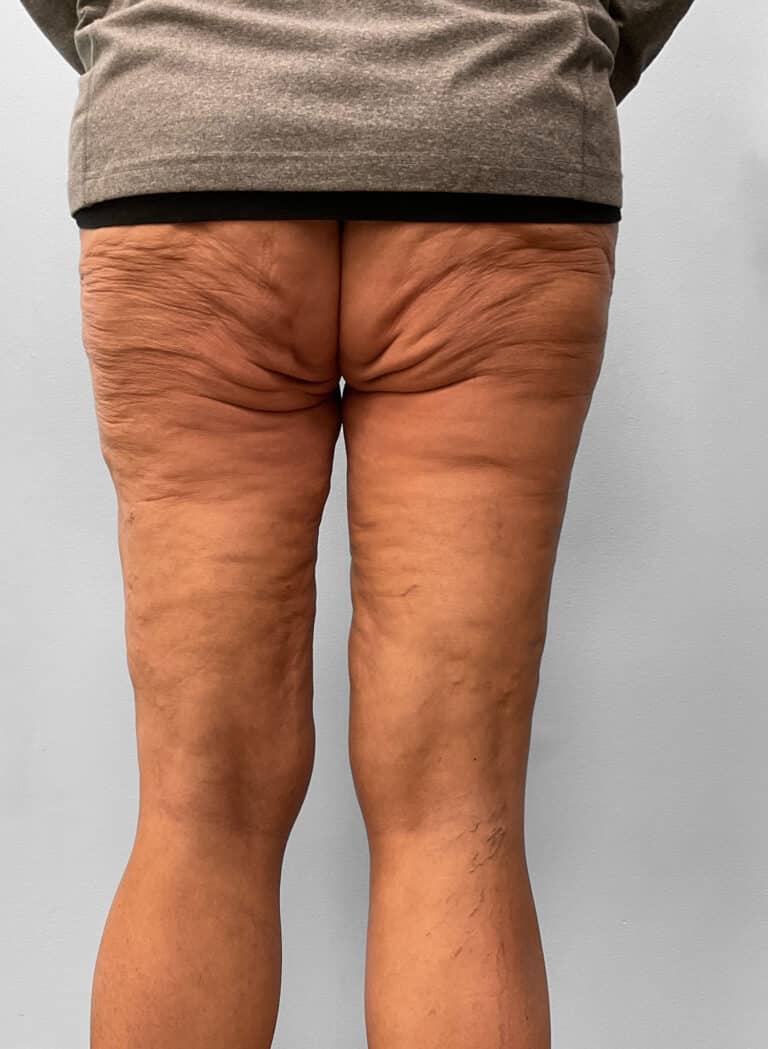 After Image: Thigh Liposuction – Dr. Howell - back
