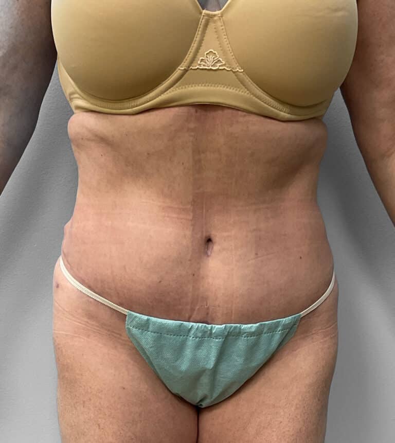 After Image: Abdominoplasty & Lipo – Dr.Howell - front