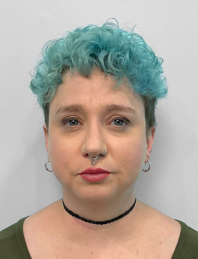 After Image: Restylane Kysse – Joy - front