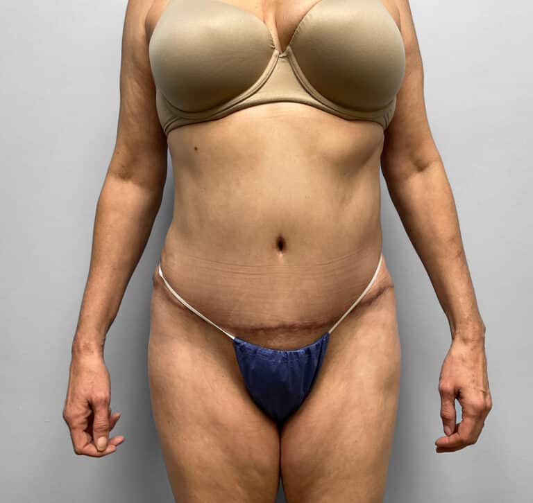 After Image: Tummy Tuck, Lipo, & BBL – Dr. Tucker - front