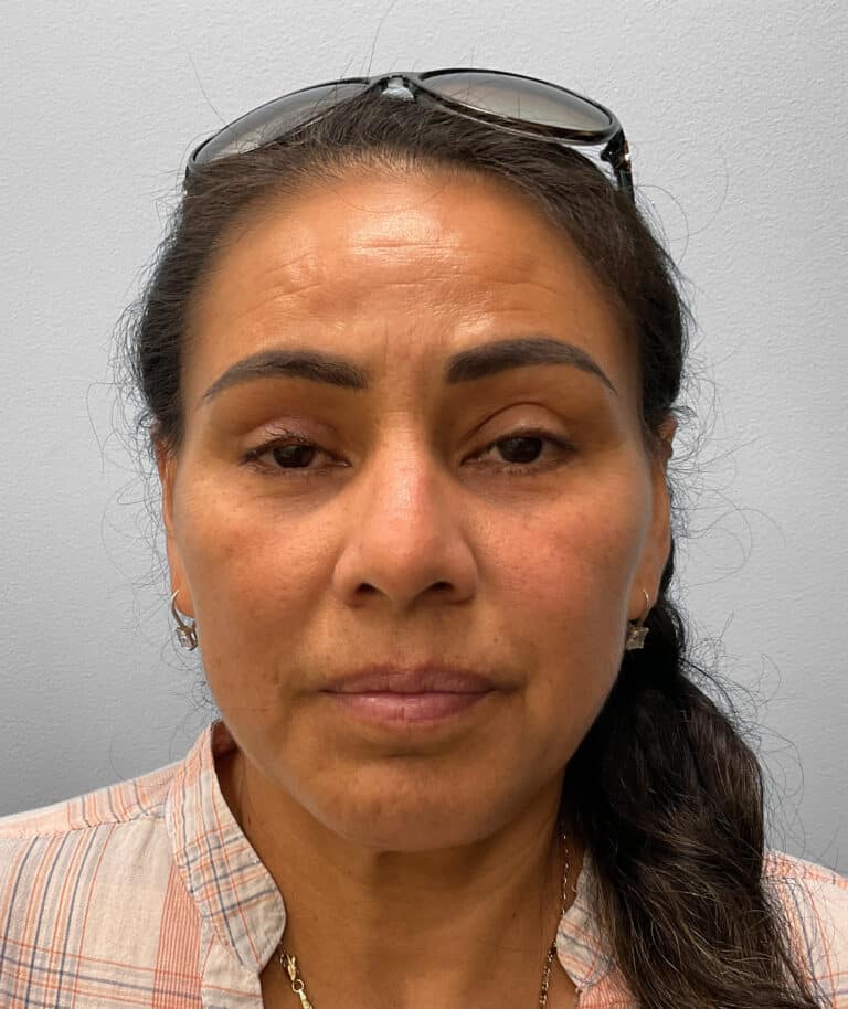After Image: Upper and Lower Blepharoplasty – Dr. Tucker - front
