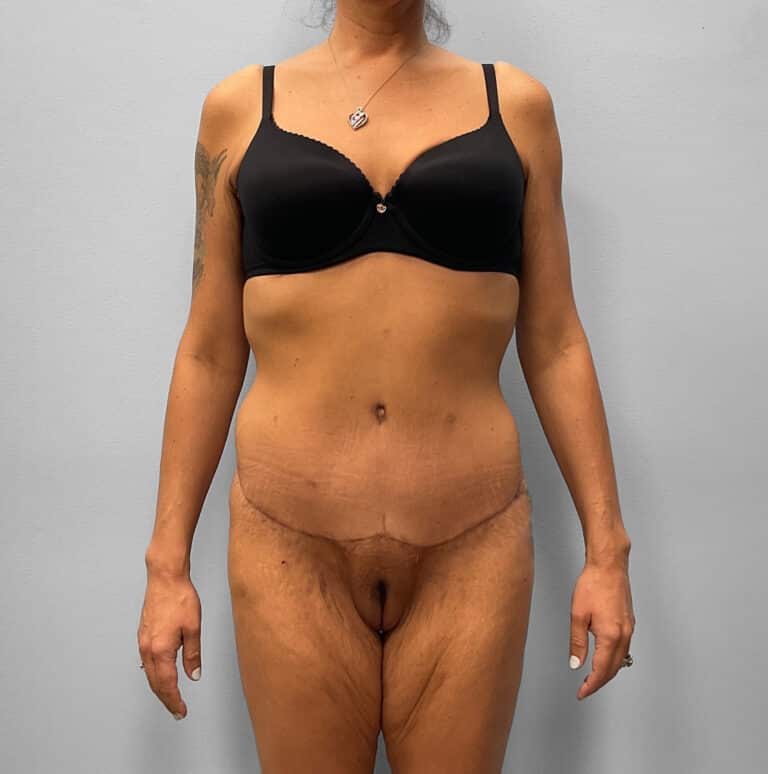 After Image: Abdominoplasty & Liposuction – Dr. Howell - front