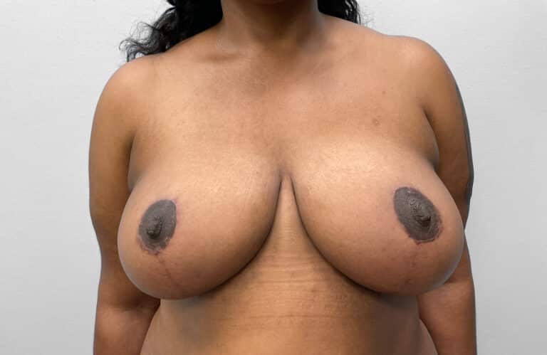 After Image: Breast & Arm Lift with Liposuction – Dr. Howell - front