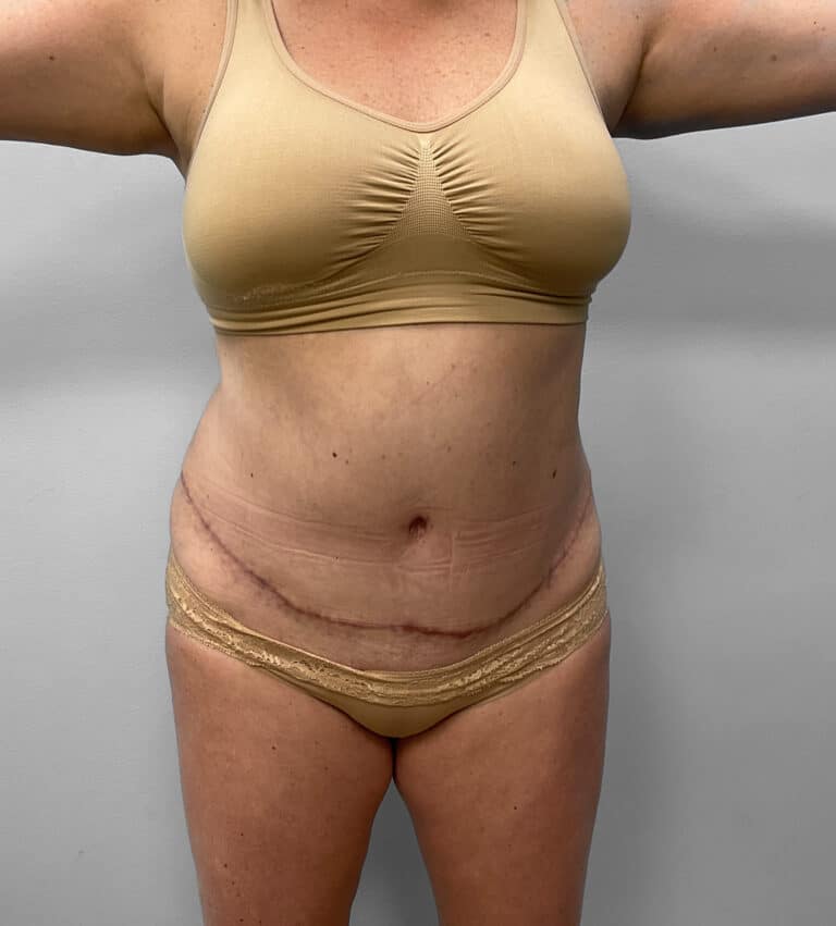 After Image: Abdominoplasty & Liposuction – Dr. Tucker - front