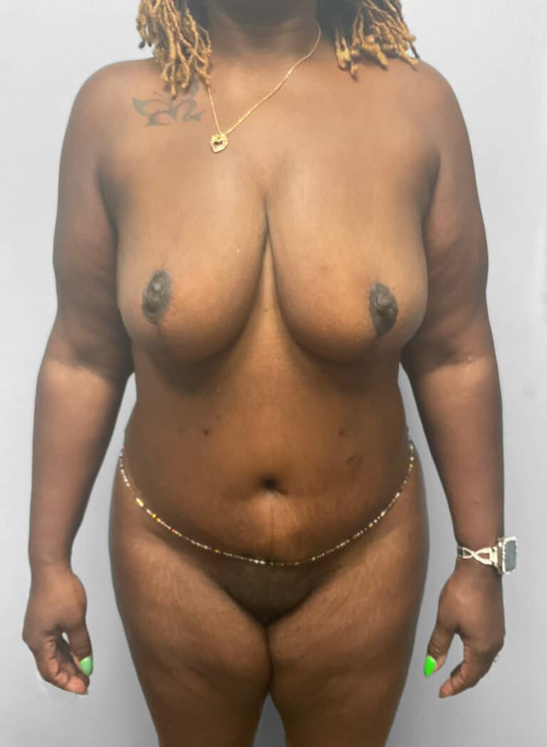 After Image: Mommy Makeover – Dr. Tucker - front