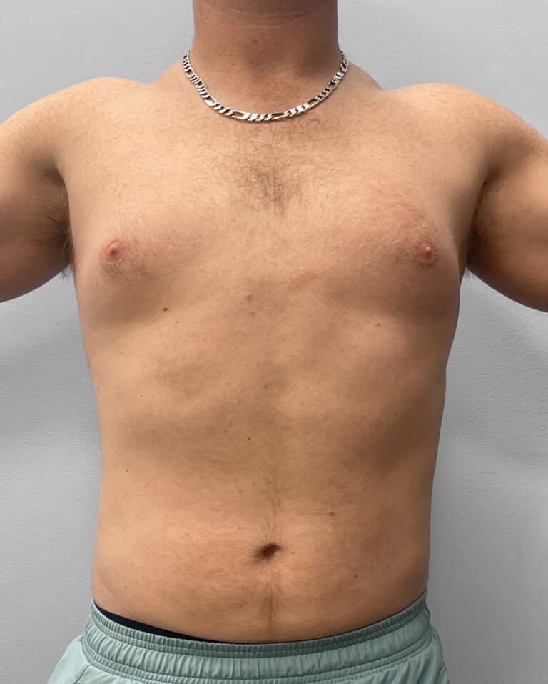 After Image: Liposuction – Dr. Tucker - front