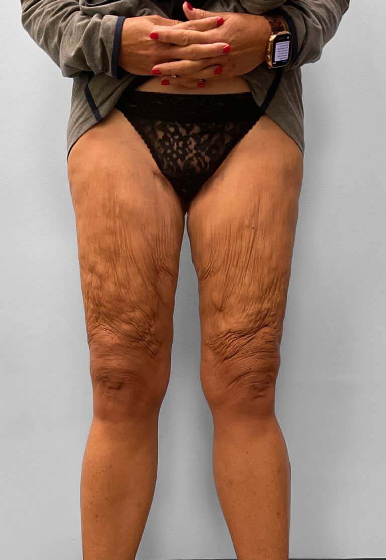 After Image: Thigh Liposuction – Dr. Howell - front