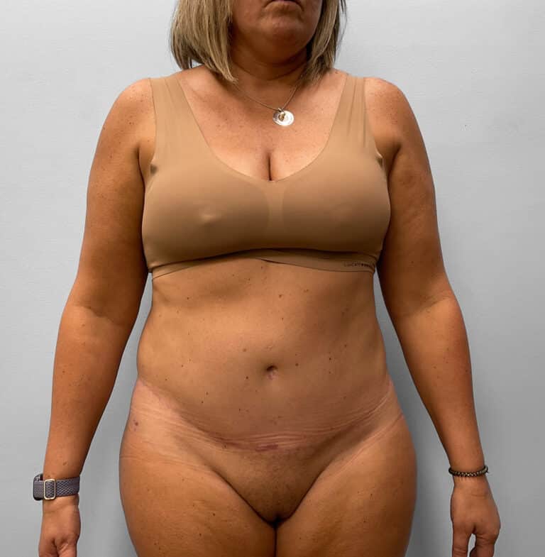 After Image: Abdominoplasty & Liposuction – Dr. Tucker - front