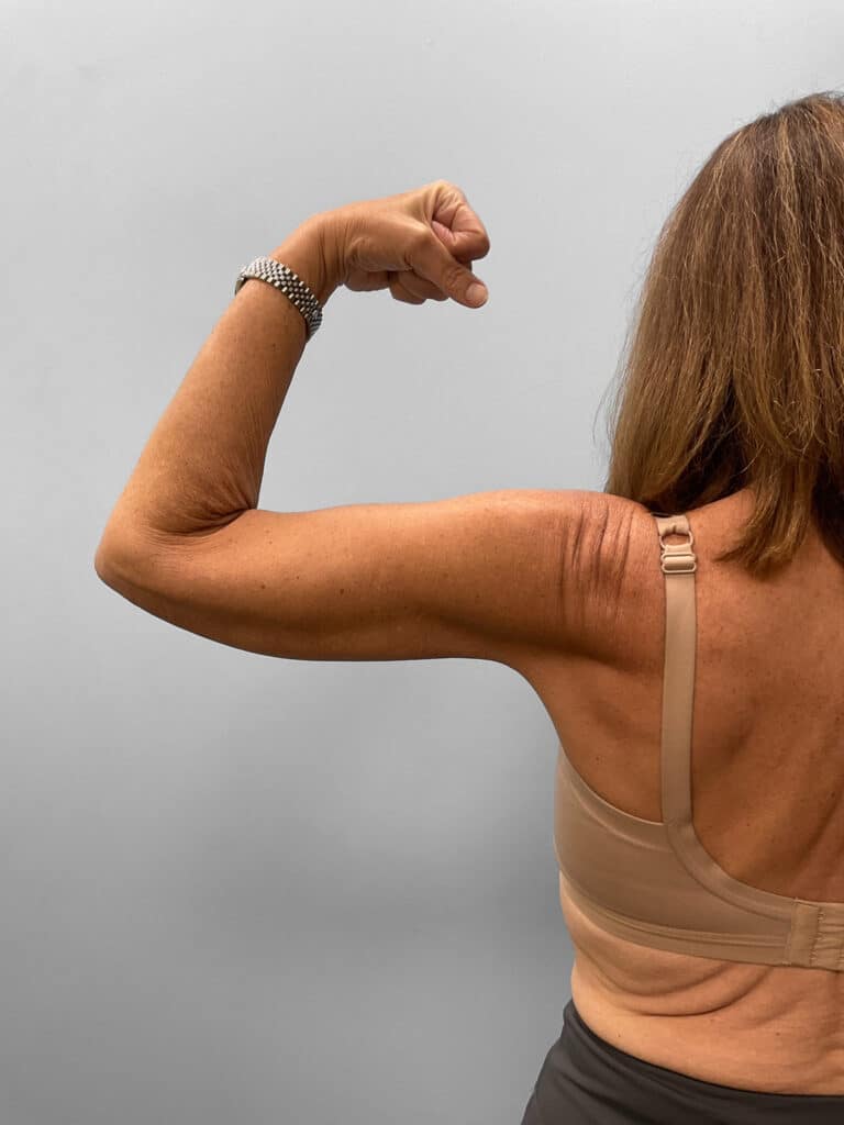 After Image: Arm Lift – Dr. Howell - back