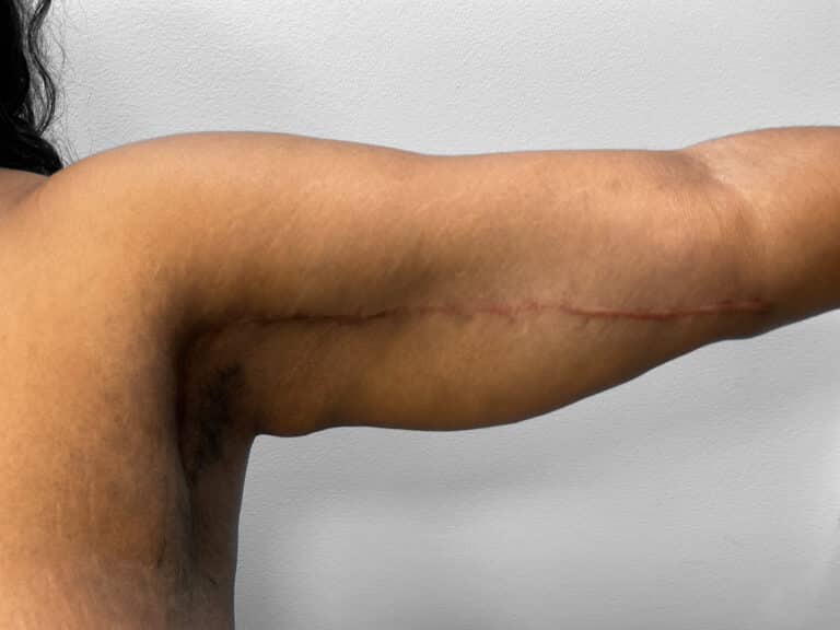 After Image: Breast & Arm Lift with Liposuction – Dr. Howell - right-side