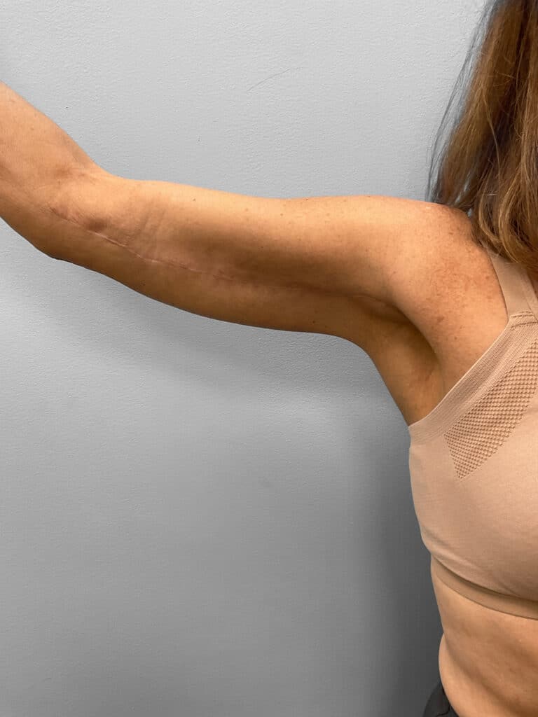 After Image: Arm Lift – Dr. Howell - front