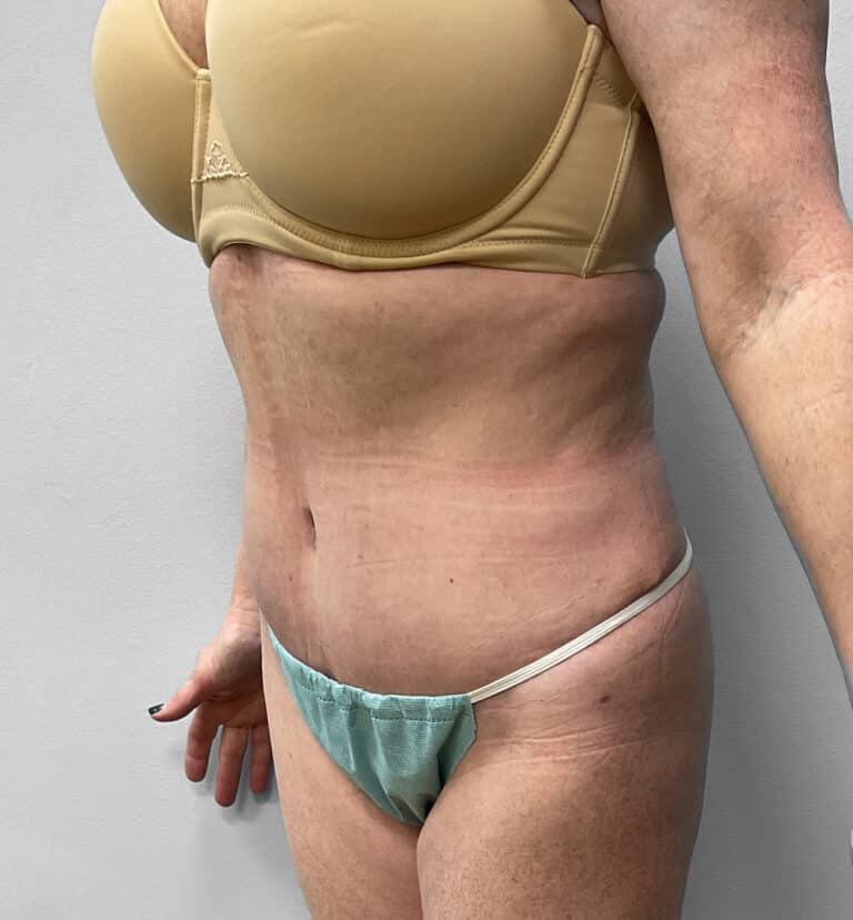 After Image: Abdominoplasty & Lipo – Dr.Howell - left-front-oblique