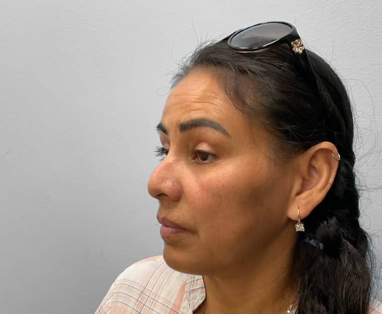 After Image: Upper and Lower Blepharoplasty – Dr. Tucker - left-front-oblique
