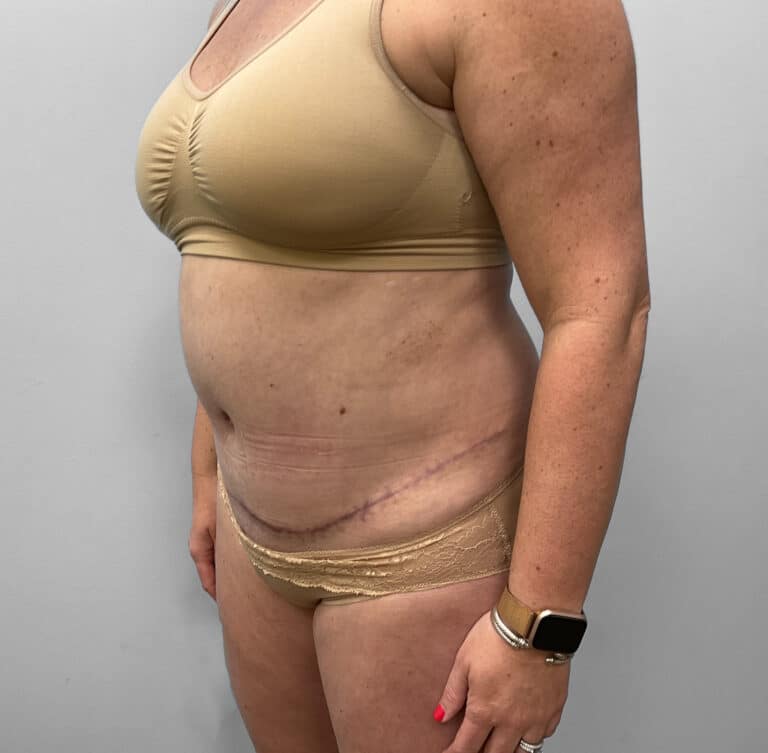 After Image: Abdominoplasty & Liposuction – Dr. Tucker - left-front-oblique