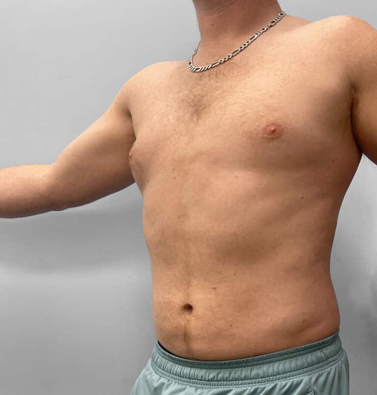After Image: Liposuction – Dr. Tucker - left-front-oblique