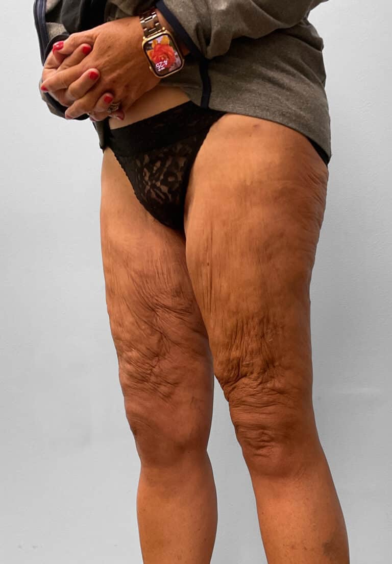 After Image: Thigh Liposuction – Dr. Howell - left-front-oblique