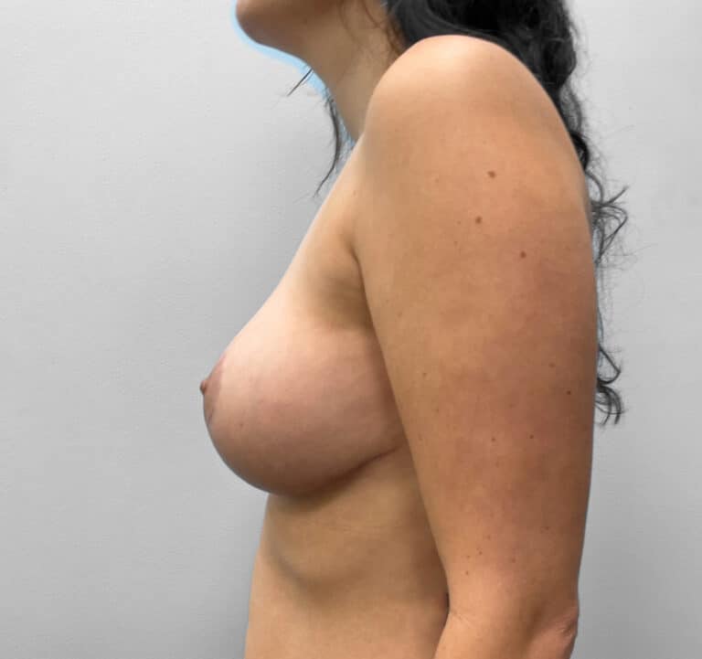 After Image: Breast Lift – Dr. Howell - left-side
