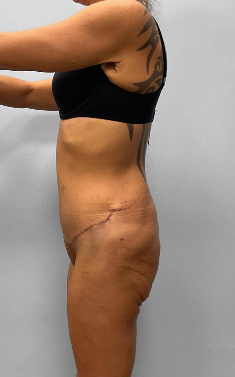 After Image: Abdominoplasty & Liposuction – Dr. Howell - left-side