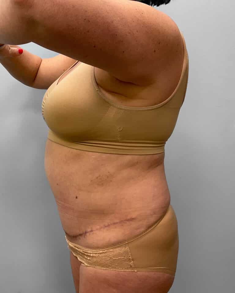 After Image: Abdominoplasty & Liposuction – Dr. Tucker - left-side