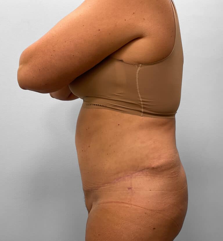 After Image: Abdominoplasty & Liposuction – Dr. Tucker - left-side