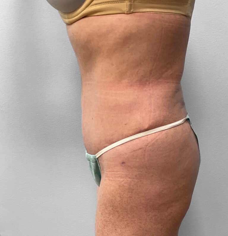 After Image: Abdominoplasty & Lipo – Dr.Howell - left-side