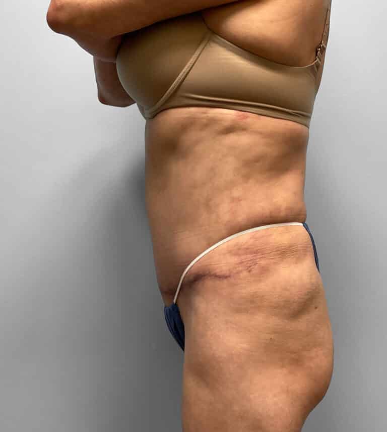 After Image: Tummy Tuck, Lipo, & BBL – Dr. Tucker - left-side