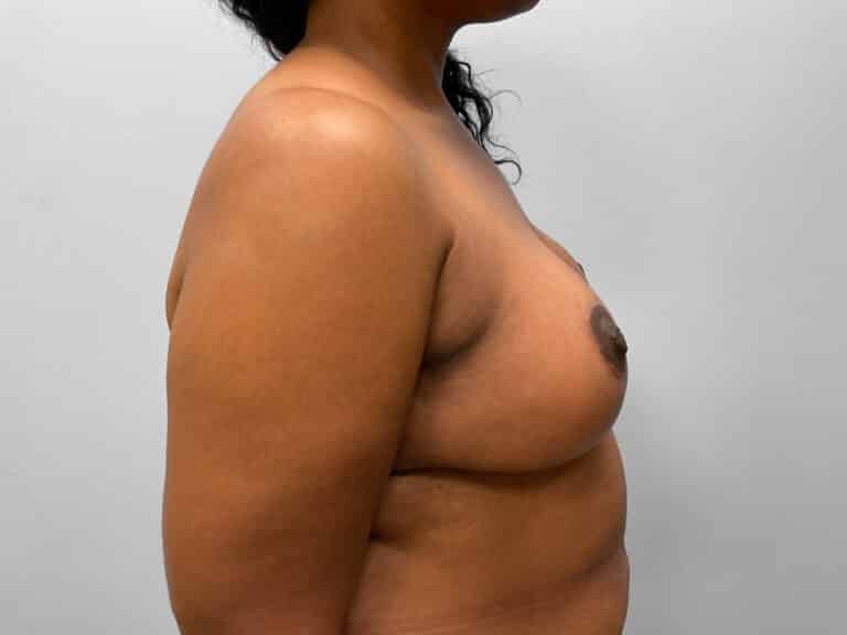 After Image: Breast & Arm Lift with Liposuction – Dr. Howell - right-side