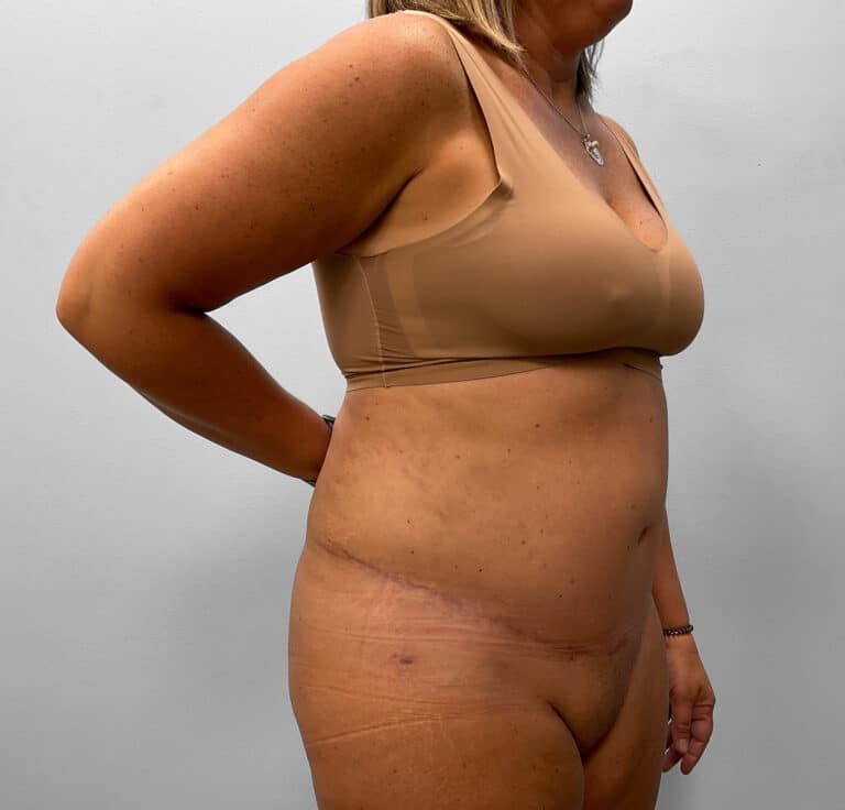 After Image: Abdominoplasty & Liposuction – Dr. Tucker - right-front-oblique