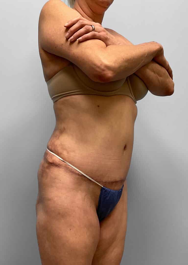 After Image: Tummy Tuck, Lipo, & BBL – Dr. Tucker - right-front-oblique