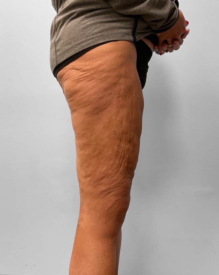 After Image: Thigh Liposuction – Dr. Howell - right-side