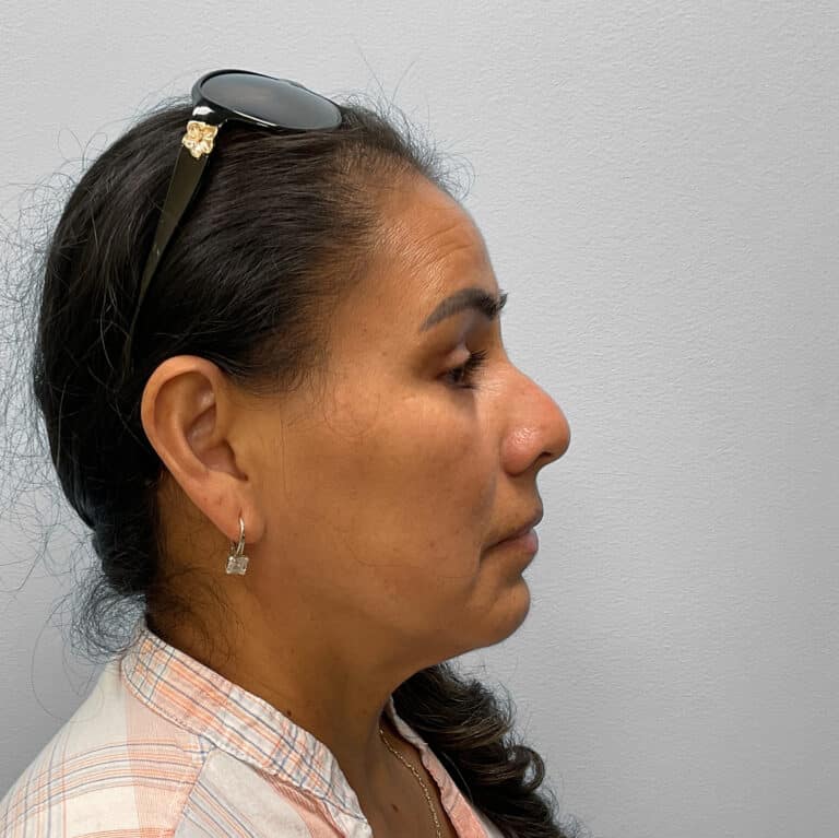 After Image: Upper and Lower Blepharoplasty – Dr. Tucker - right-side