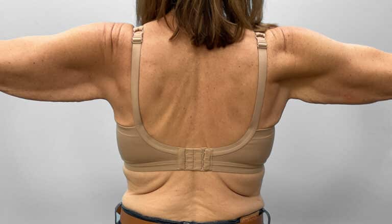 Before Image: Arm Lift – Dr. Howell - back
