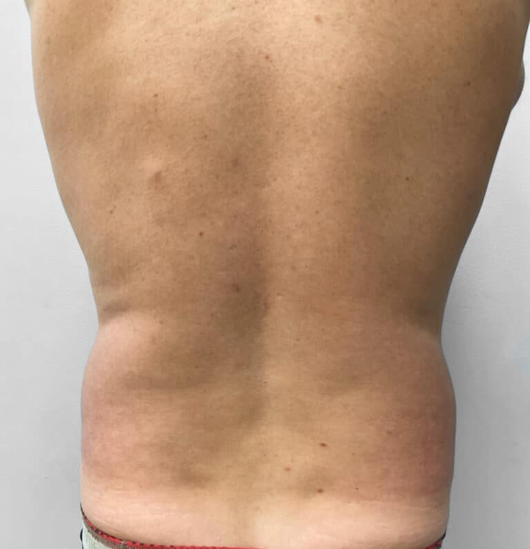 Before Image: Liposuction – Dr. Tucker -