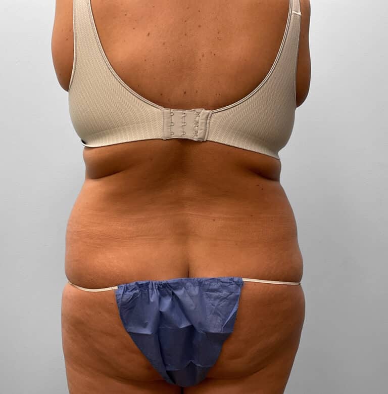 Before Image: Abdominoplasty & Liposuction – Dr. Tucker - back
