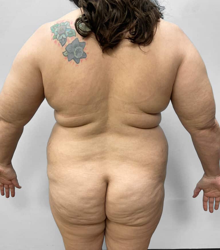 Before Image: Tummy Tuck, Lipo, & BBL – Dr. Tucker - back