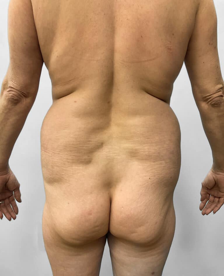 Before Image: Tummy Tuck, Lipo, & BBL – Dr. Tucker - front